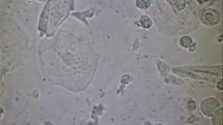 Krebszellen Möbel Ca4 (durch sterile Urinsediment und sty