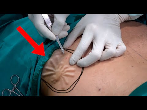 Creatures Found Living INSIDE A Human Body!