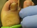 Ingrown Toenail Removal Surgery
