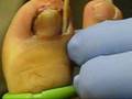 Ingrown Toenail Removal Surgery