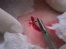 Sam gets stiches