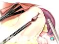 videos de Medical Malpractice Spleen Removal Laparoscopic Splenectomy Surgery 4