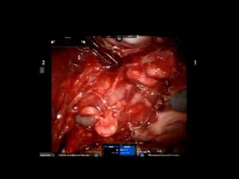 how to get a uterus transplant
