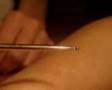 Acupuntura japonesa, una técnica muy particular