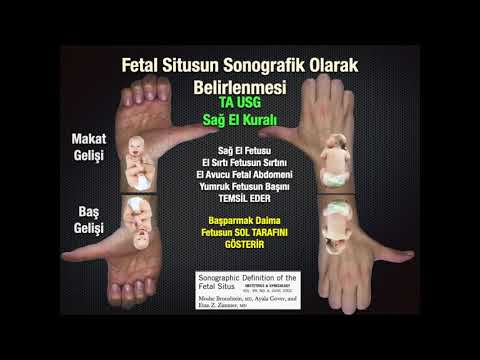 ŞUBAT 2021 AYI OLGUSU - Fetal Kalbin Embriyolojik Gelişimi ve Fetal Situsun Belirlenmesi - Dr. Namık DEMİR