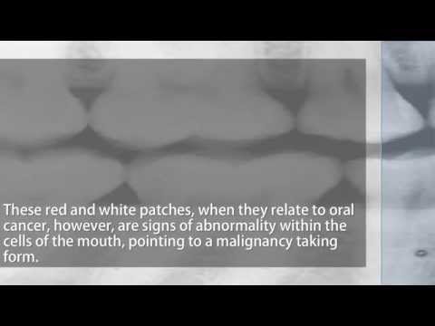 how to cure oral cancer