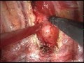 Schwannoma Excision With A Thoracoscopy Without Any Nerve Damage Schwannoma Excision With A Thoracoscopy Without Any Nerve Damage