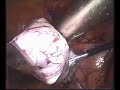 Laparoscopic bilat�ral genital adnexectomy