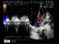 echocardiogram : cor triatrium cw