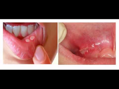 how to relieve tongue ulcers
