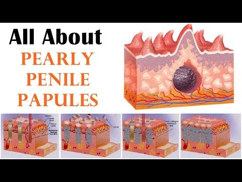 Causes pearly papules what penile Can pearly