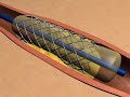Short stent animation used in a medical training course created by Xcelus Studios.