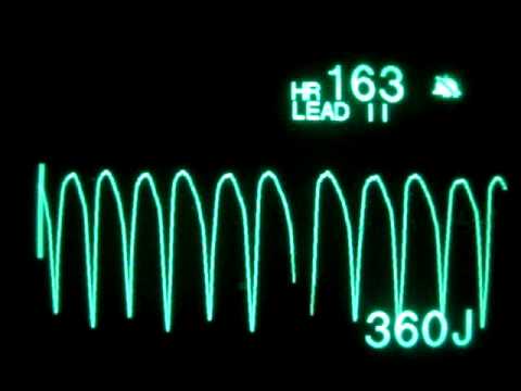 how to treat pulseless vt