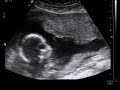 My Baby's Ultrasound at 19 weeks