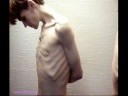 Anorexia: The Ten Most Common Misconceptions About E.D.\