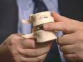 videos de PRODISC® Lumbar Artificial Disc Replacement Surgery - The Spine Institute Santa Monica CA