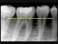 Enfermedad periodontal 1 Enfermedad periodontal 1