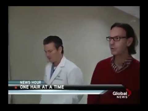 Video ARTAS FUE Hair Transplant (Robotic Hair Transplant) in Toronto