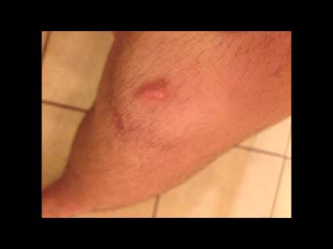 how to get rid of keloid c-section scar
