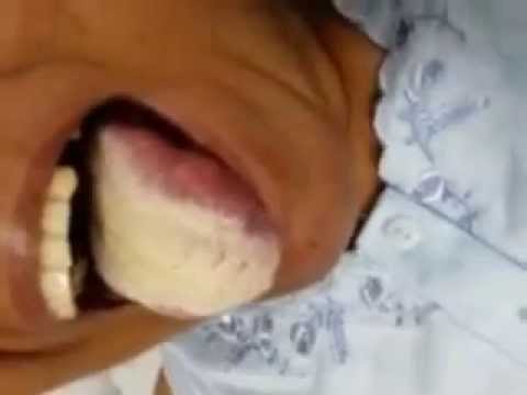 how to cure sore tongue
