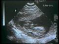 Ecografia di un aborto