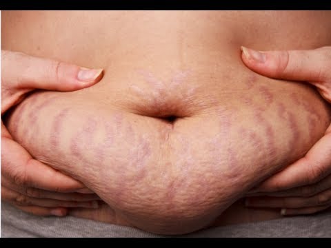 how to get rid stretch marks