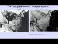 Missing JFK Autopsy Photo Found - JFK Autopsy Part I