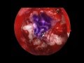 Endoscopic Endonasal Craniopharyngioma Resection