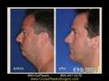 Neck Lift / Chin Implant / Rhinoplasty Part 3, Dr. Cruise