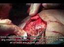 Brain Operation in Butuan in Ilonggo Cebuano Visaya 1C