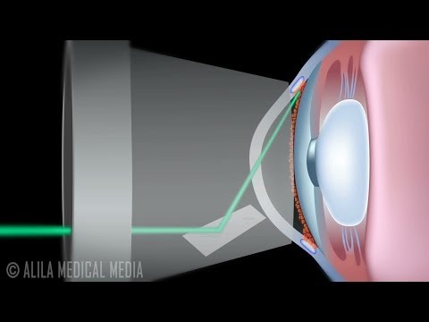 how to control glaucoma