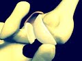 Shoulder Recurrent Dislocation