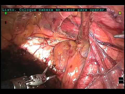 hernioplastia - Video Library . Hernioplastia inguinal derecha con colocacion de malla asistida por robot Página CIMI contiene una gama amplia de videos informativos, para m...