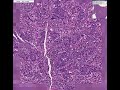 Histopathology Breast--Medullary carcinoma