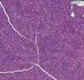 Histopathology Breast--Medullary carcinoma