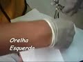 Alargador de 0 a 10mm no Bisturi Alargador de 0 a 10mm no Bisturi