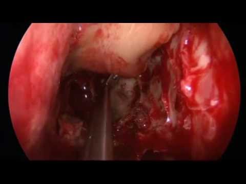 how to treat csf leak