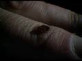 What Do Bedbug bites Look Like