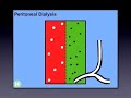 Hemodialysis