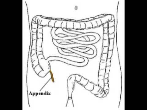 how to cure appendicitis