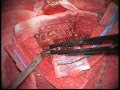 1^ parte. Glioma temporale sinistro. Microchirurgia intervento completo