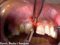 Cirurgia de Frenectomia