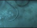 Ruby laser removal of lentigenes Ruby laser removal of lentigenes