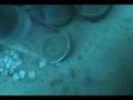Ruby laser removal of lentigenes