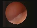 essure