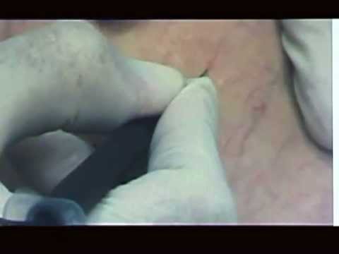 A varicosity per gambe il prezzo