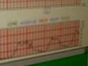 Contraction Contraction
