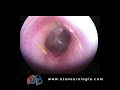 Normal tympanic membrane