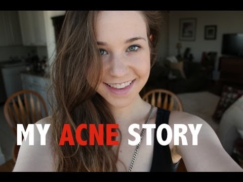 how to deal with acne