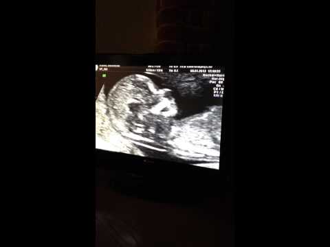 The 13 week ultrasound scan of our beautiful baby